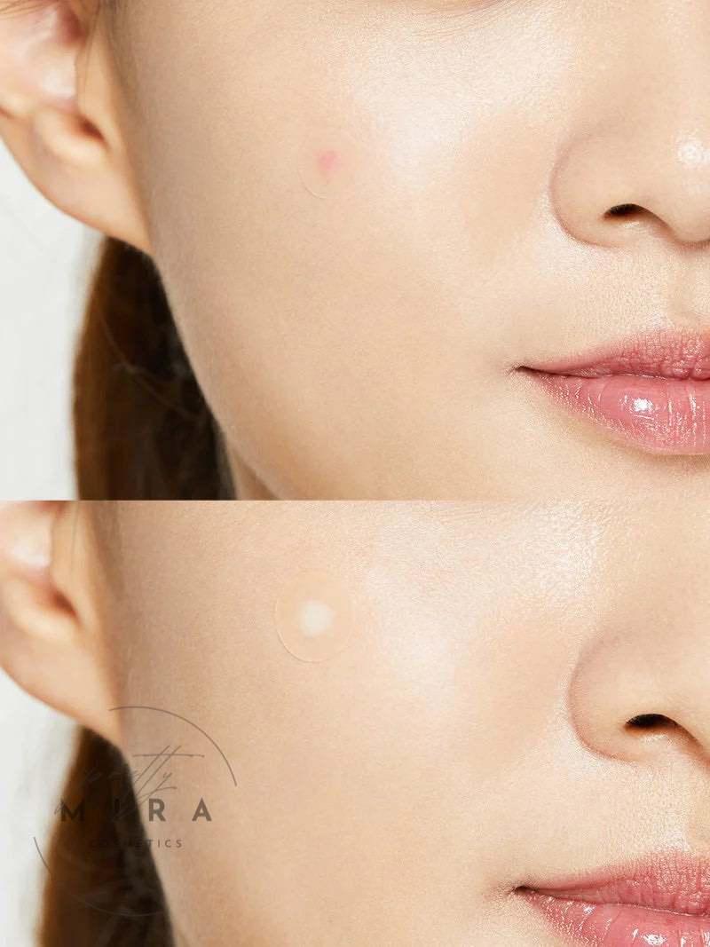 COSRX Acne Pimple Master 24ea x 5 - Pretty Mira Shop